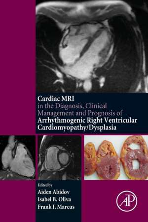 Cardiac MRI in Diagnosis, Clinical Management, and Prognosis of Arrhythmogenic Right Ventricular Cardiomyopathy/Dysplasia de Aiden Abidov