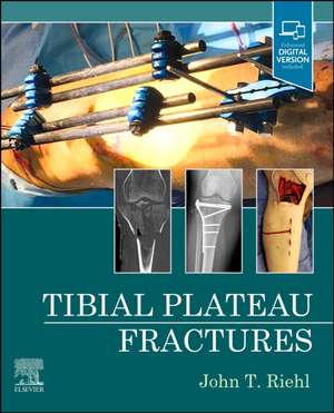 Tibial Plateau Fractures de John Riehl