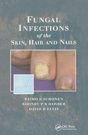 Fungal Infections of the Skin and Nails de Raimo E. Suhonen