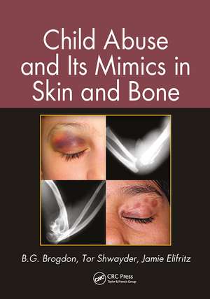 Child Abuse and its Mimics in Skin and Bone de B. G. Brogdon