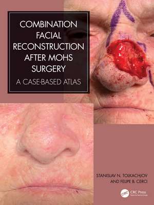 Combination Facial Reconstruction after Mohs Surgery: A Case Based Atlas de Stanislav N. Tolkachjov