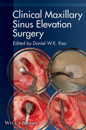 Clinical Maxillary Sinus Elevation Surgery: Kao Chirurgia de elevație a sinusurilor de DWK Kao