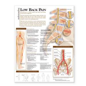 Understanding Low Back Pain Anatomical Chart de Anatomical Chart Company