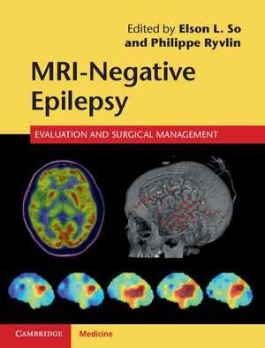 MRI-Negative Epilepsy: Evaluation and Surgical Management de Elson L. So