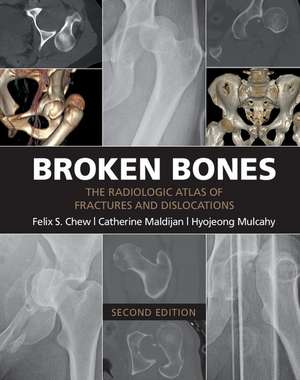 Broken Bones: The Radiologic Atlas of Fractures and Dislocations de Felix S. Chew