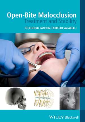 Open–Bite Malocclusion – Treatment and Stability de G Janson