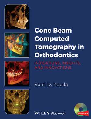 Cone Beam Computed Tomography in Orthodontics – Indications, Insights, and Innovations de S Kapila