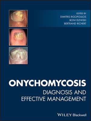 Onychomycosis de Dimitris Rigopoulos