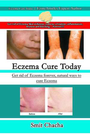 Eczema Cure Today - Get rid of Eczema forever natural ways to cure Eczema de Smit Chacha