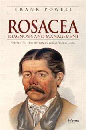 Rosacea: Diagnosis and Management de Frank Powell