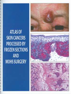 Atlas of Skin Cancers Processed by Frozen Sections and Mohs Surgery de Stephen N. Snow