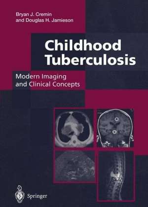 Childhood Tuberculosis: Modern Imaging and Clinical Concepts de Bryan J. Cremin