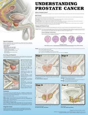 Understanding Prostate Cancer 2e Paper de Anatomical Chart Company