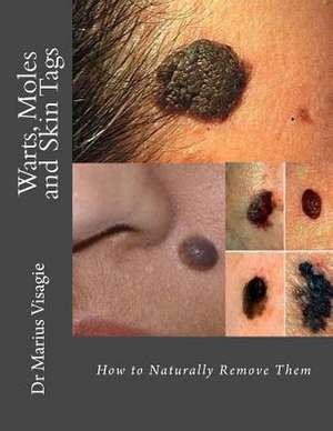 Warts, Moles and Skin Tags de Visagie, Dr Marius