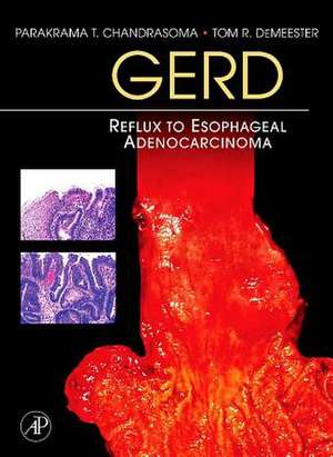 Gerd: Reflux to Esophageal Adenocarcinoma de Parakrama T. Chandrasoma