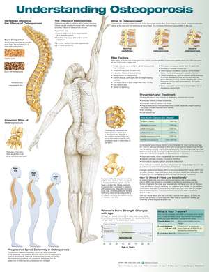 Understanding Osteoporosis Anatomical Chart de Anatomical Chart Company