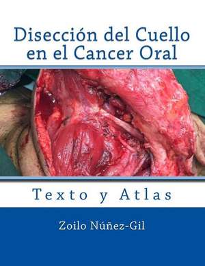 Diseccion del Cuello En El Cancer Oral de Nunez-Gil, Dr Zoilo