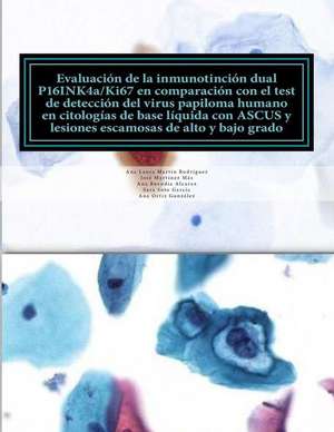 Evaluacion de La Inmunotincion Dual P16ink4a/Ki67 En Comparacion Con El Test del Virus del Papiloma Humano En Citologias de Base Liquida Con Ascus y L de Ana Laura Martin Rodriguez