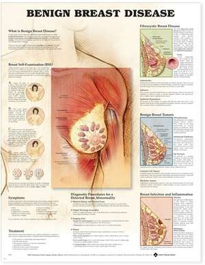 Benign Breast Disease Anatomical Chart de Anatomical Chart Company