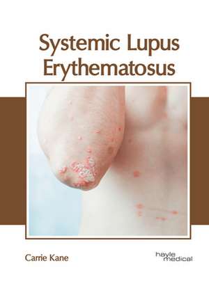 Systemic Lupus Erythematosus de Carrie Kane