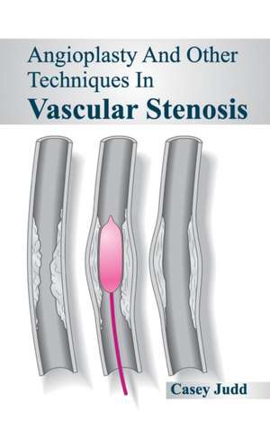 Angioplasty and Other Techniques in Vascular Stenosis de Casey Judd