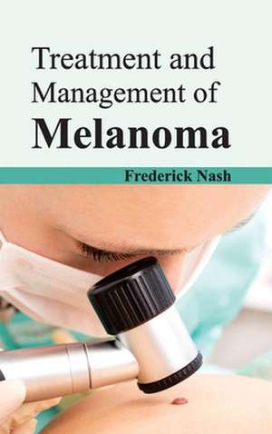 Treatment and Management of Melanoma de Frederick Nash