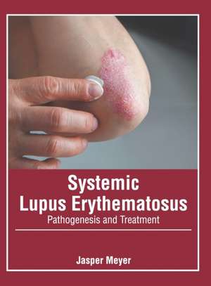 Systemic Lupus Erythematosus: Pathogenesis and Treatment de Jasper Meyer