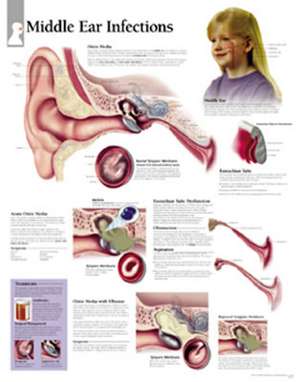 Middle Ear Infection Chart: Wall Chart de Scientific Publishing