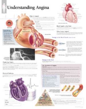 Understanding Angina Laminated Poster de Scientific Publishing