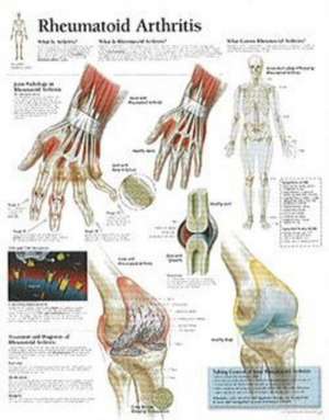 Rheumatoid Arthritis de Scientific Publishing