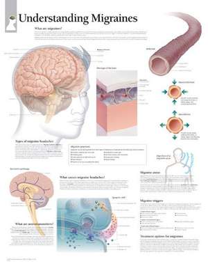 Understanding Migraines Laminated Poster de Scientific Publishing