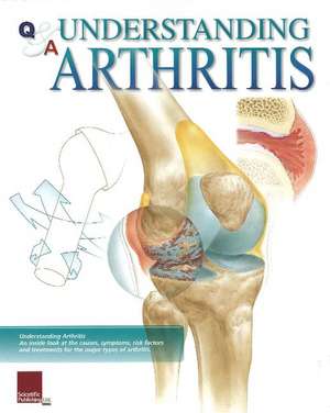 Understanding Arthritis Flip Chart de Scientific Publishing