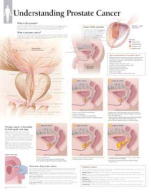 Understanding Prostate Cancer Paper Poster de Scientific Publishing