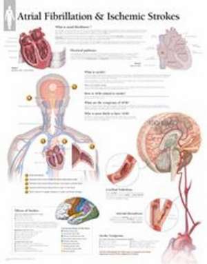 Atrial Fib & Ischemic Strokes Laminated Poster de Scientific Publishing