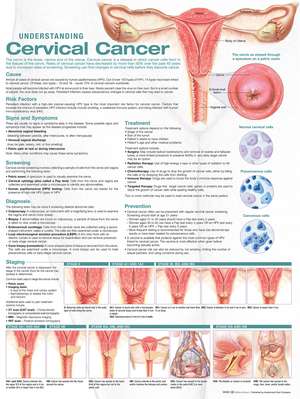 Understanding Cervical Cancer Anatomical Chart de Anatomical Chart Company