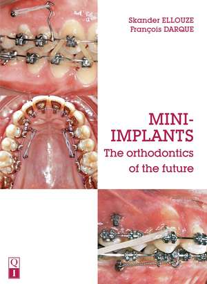 Mini-Implants: The orthodontics of the future de Skander Ellouze