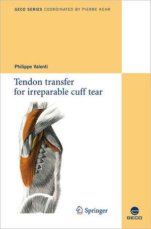 Tendon transfer for irreparable cuff tear de Philippe Valenti