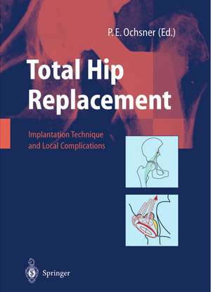 Total Hip Replacement: Implantation Technique and Local Complications de R. Hinchliffe