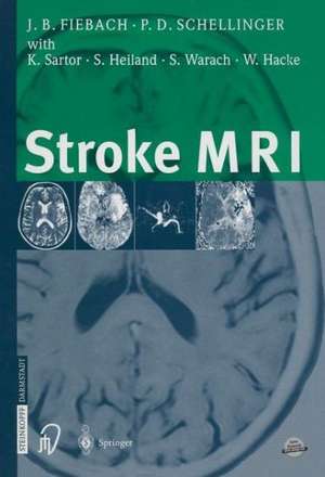 Stroke MRI de Jochen Fiebach