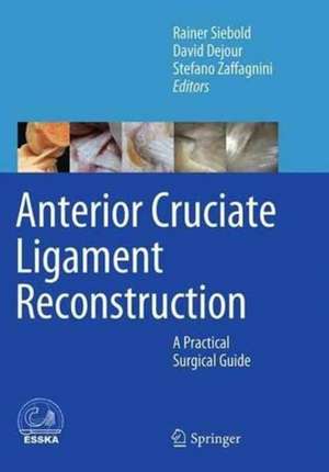 Anterior Cruciate Ligament Reconstruction: A Practical Surgical Guide de Rainer Siebold