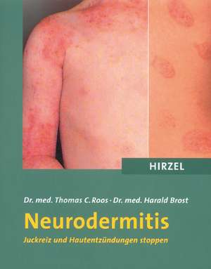 Neurodermitis de Thomas C. Roos