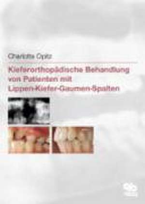 Kieferorthopädische Behandlung von Patienten mit Lippen-Kiefer-Gaumen-Spalten de Charlotte Opitz