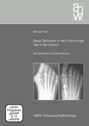 Neue Techniken in der Fußchirurgie - Das V-tek-System de Michael Vitek