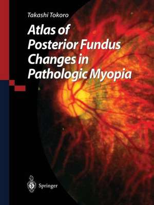 Atlas of Posterior Fundus Changes in Pathologic Myopia de Takashi Tokoro