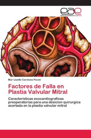 Factores de Falla en Plastia Valvular Mitral de Mar Lisette Carmona Pavon