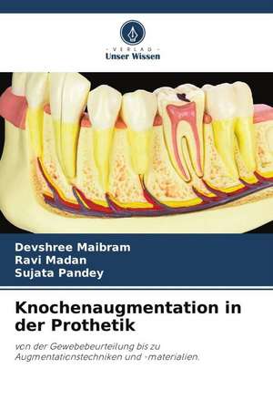 Knochenaugmentation in der Prothetik de Devshree Maibram