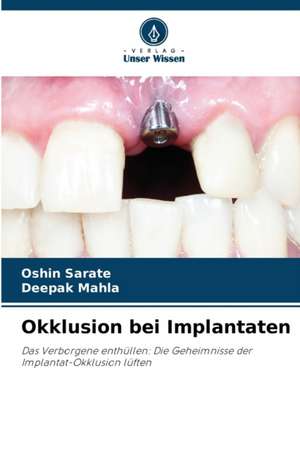 Okklusion bei Implantaten de Oshin Sarate