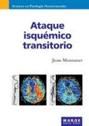 Ataque isquémico transitorio de Joan Montaner