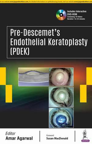 Pre-Descemet’s Endothelial Keratoplasty (PDEK) de Amar Agarwal