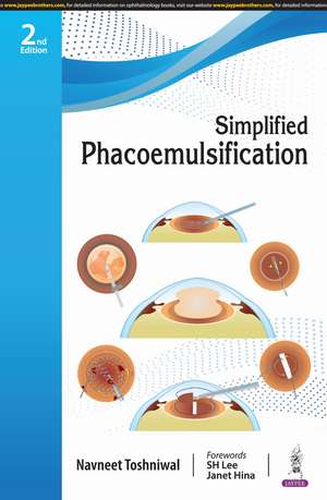 Simplified Phacoemulsification de Navneet Toshniwal